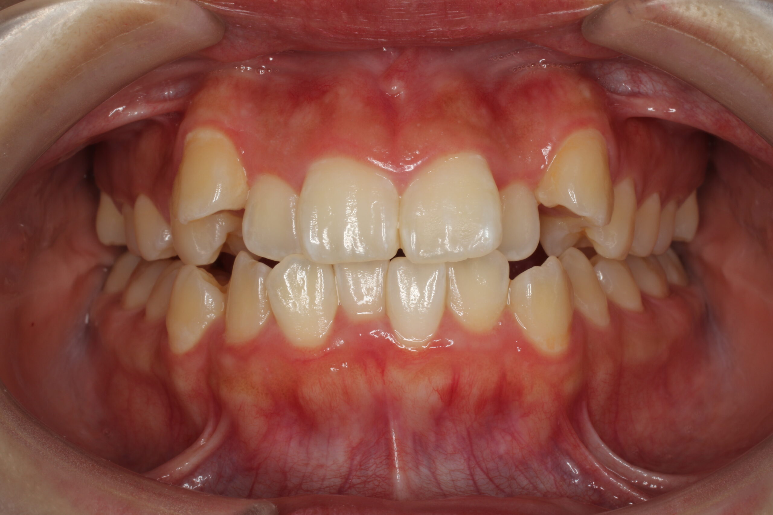 八重歯　治療前　難波矯正歯科