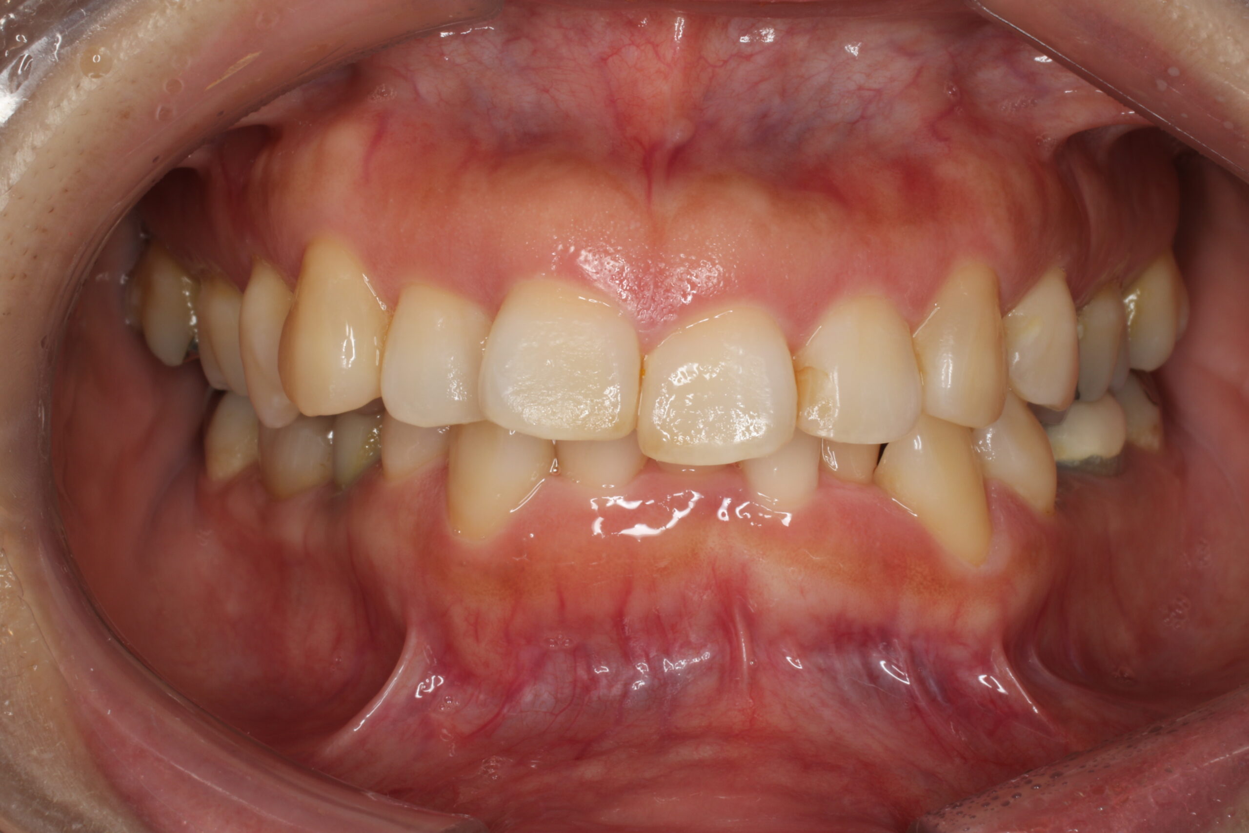 過蓋咬合　症例　難波