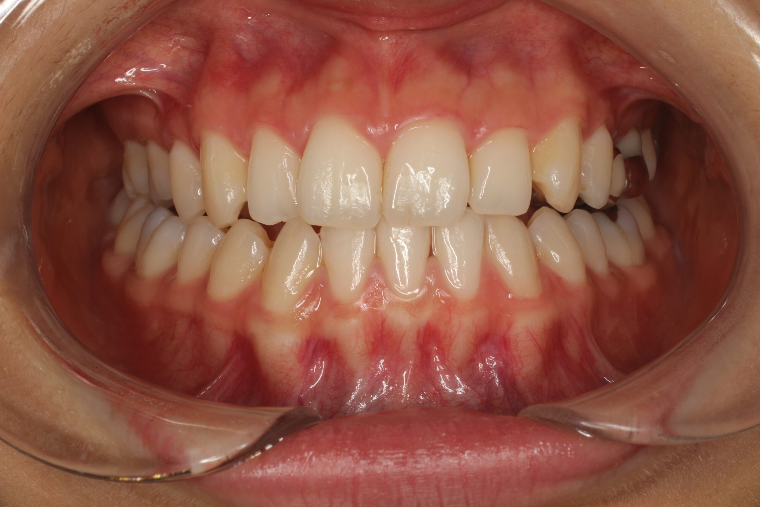 初診　矯正　難波