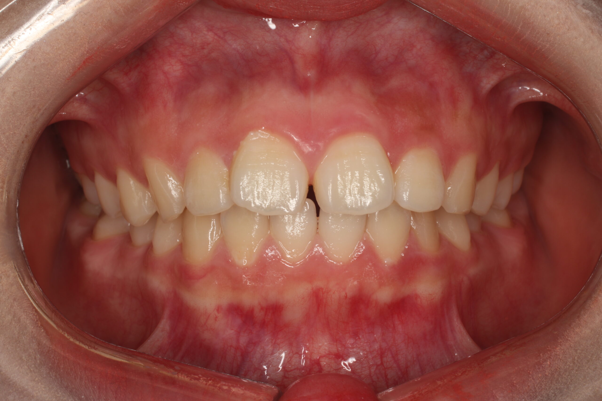 すきっぱ　矯正前　難波矯正歯科