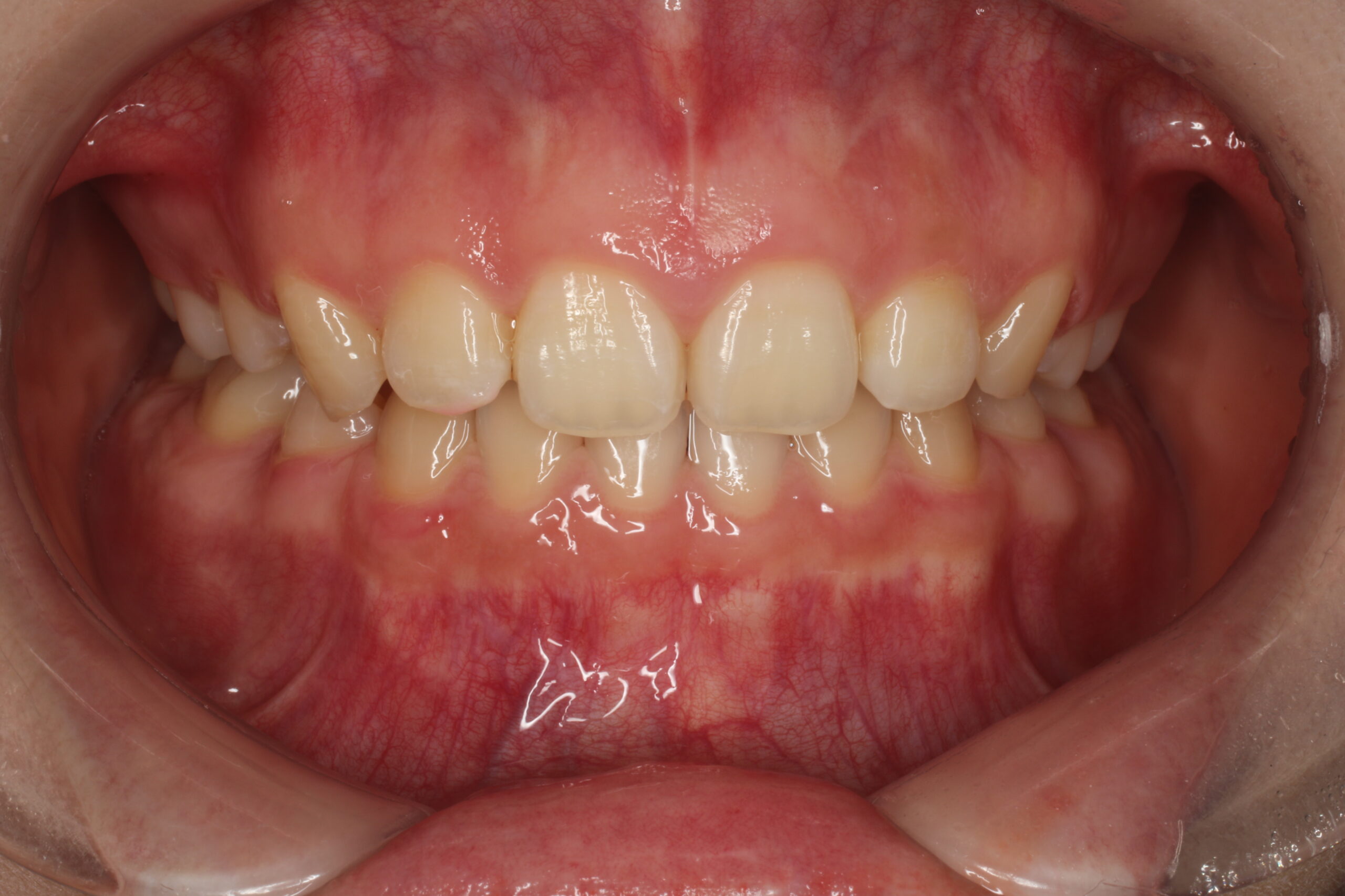 裏側矯正後　難波　矯正歯科