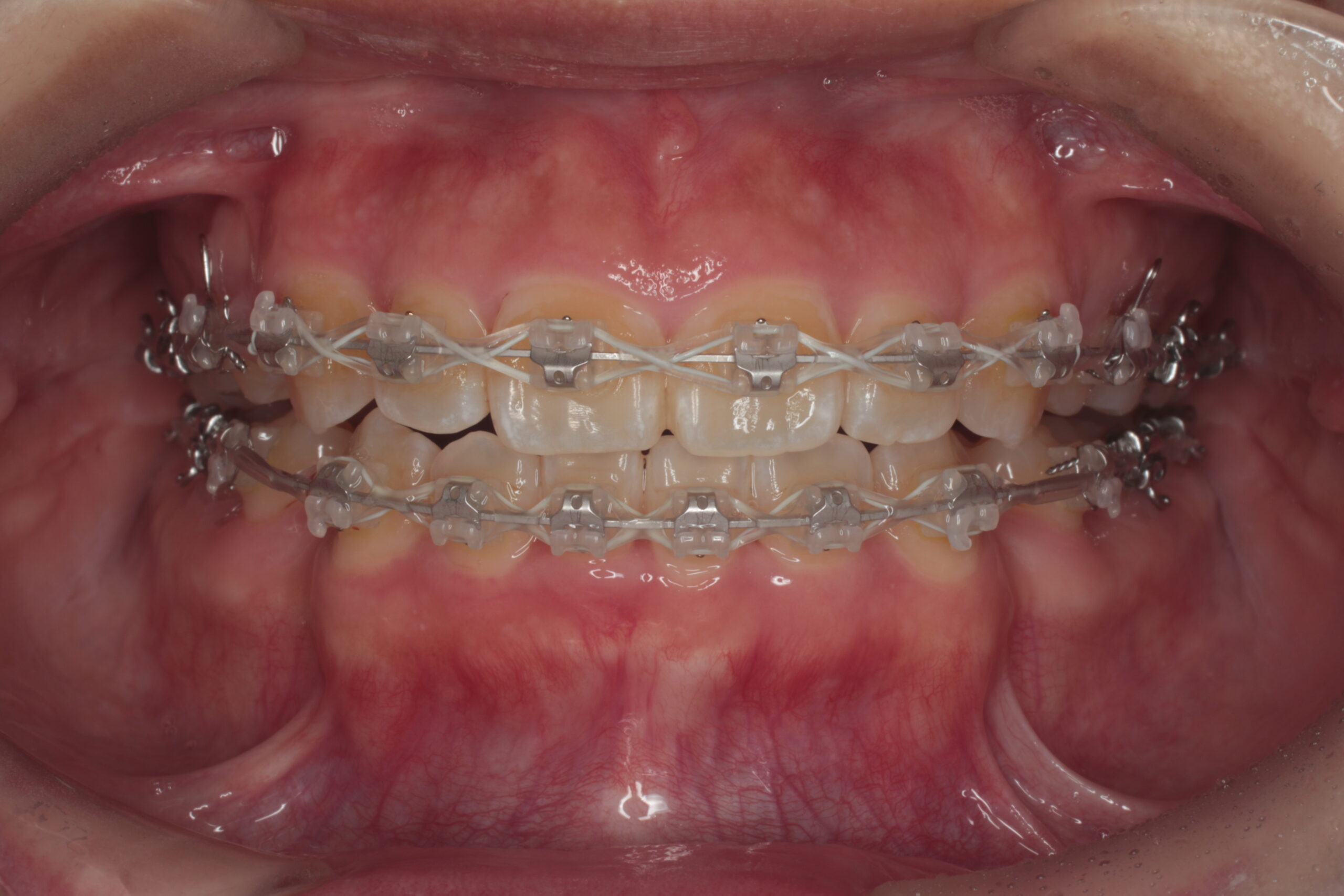 治療途中　難波　矯正歯科