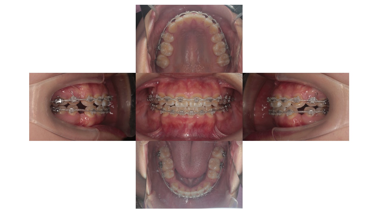 1年2か月経過時
