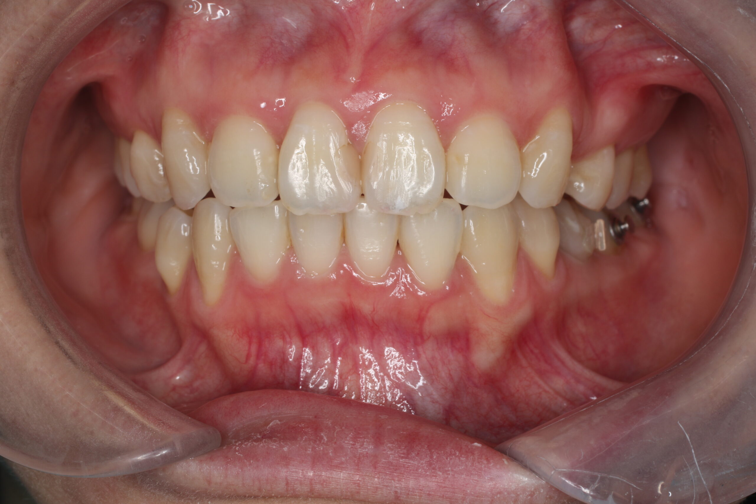 After　裏側矯正　経過途中