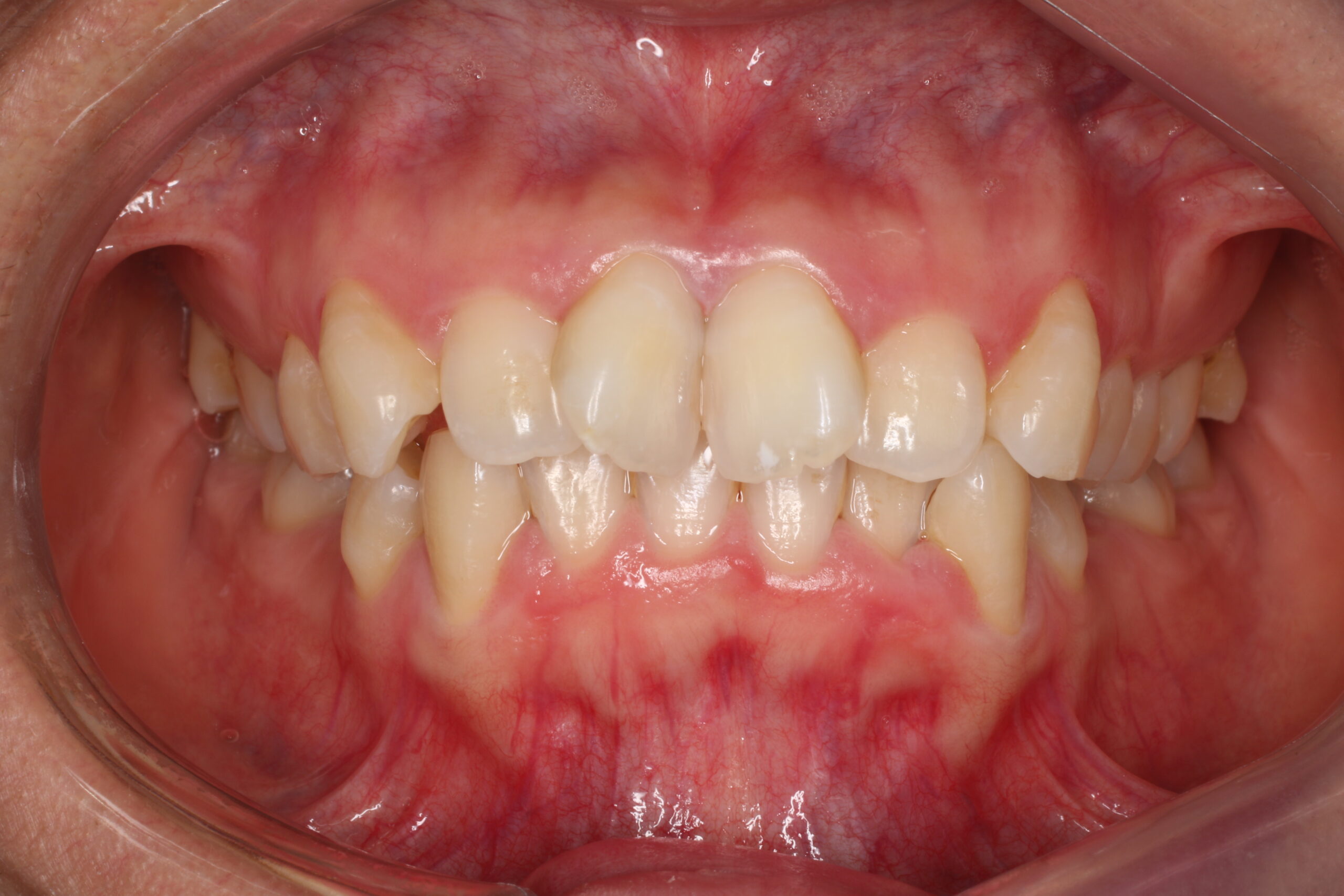 叢生　歯列矯正　before