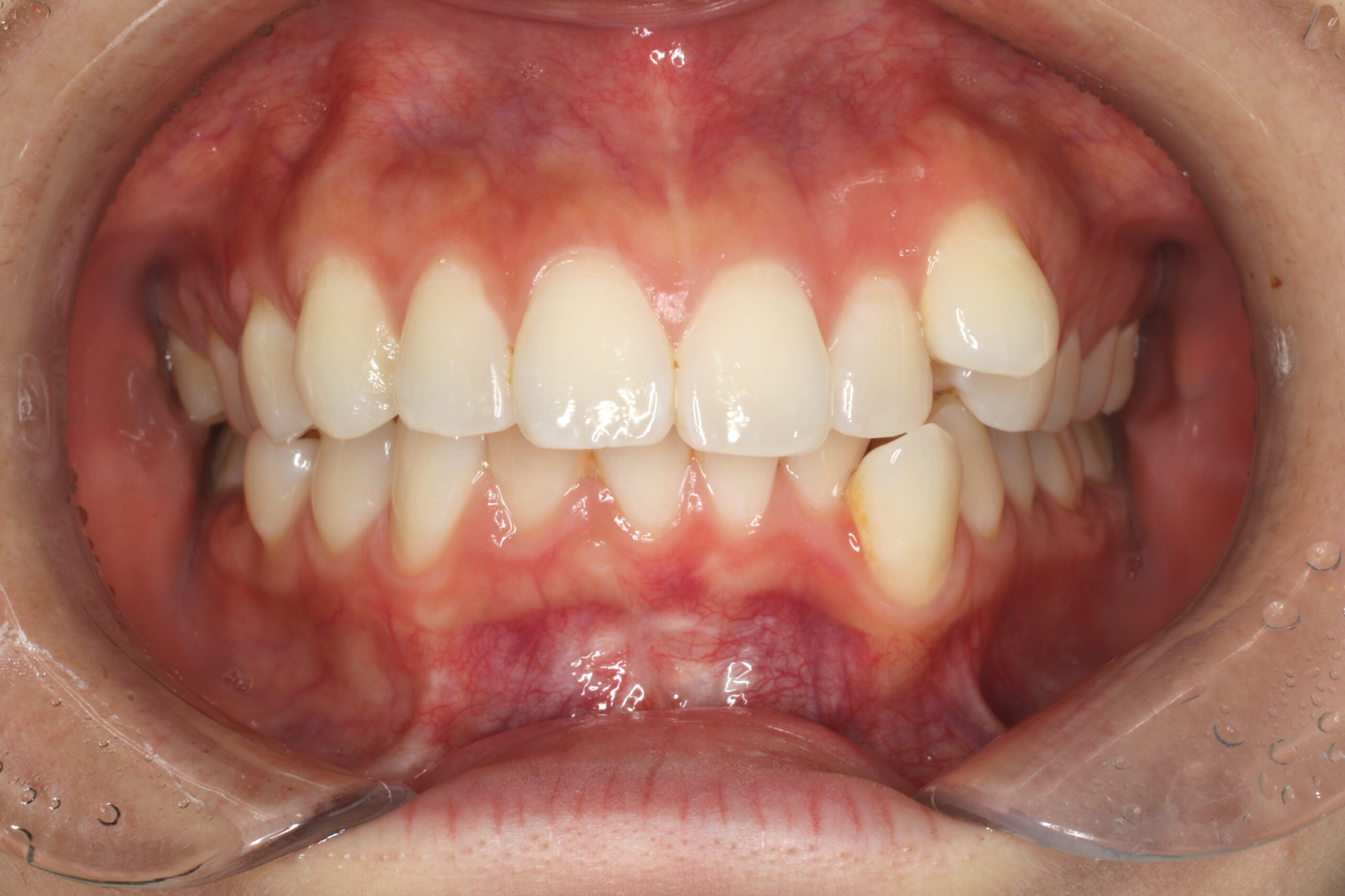 初診　口腔内写真　難波