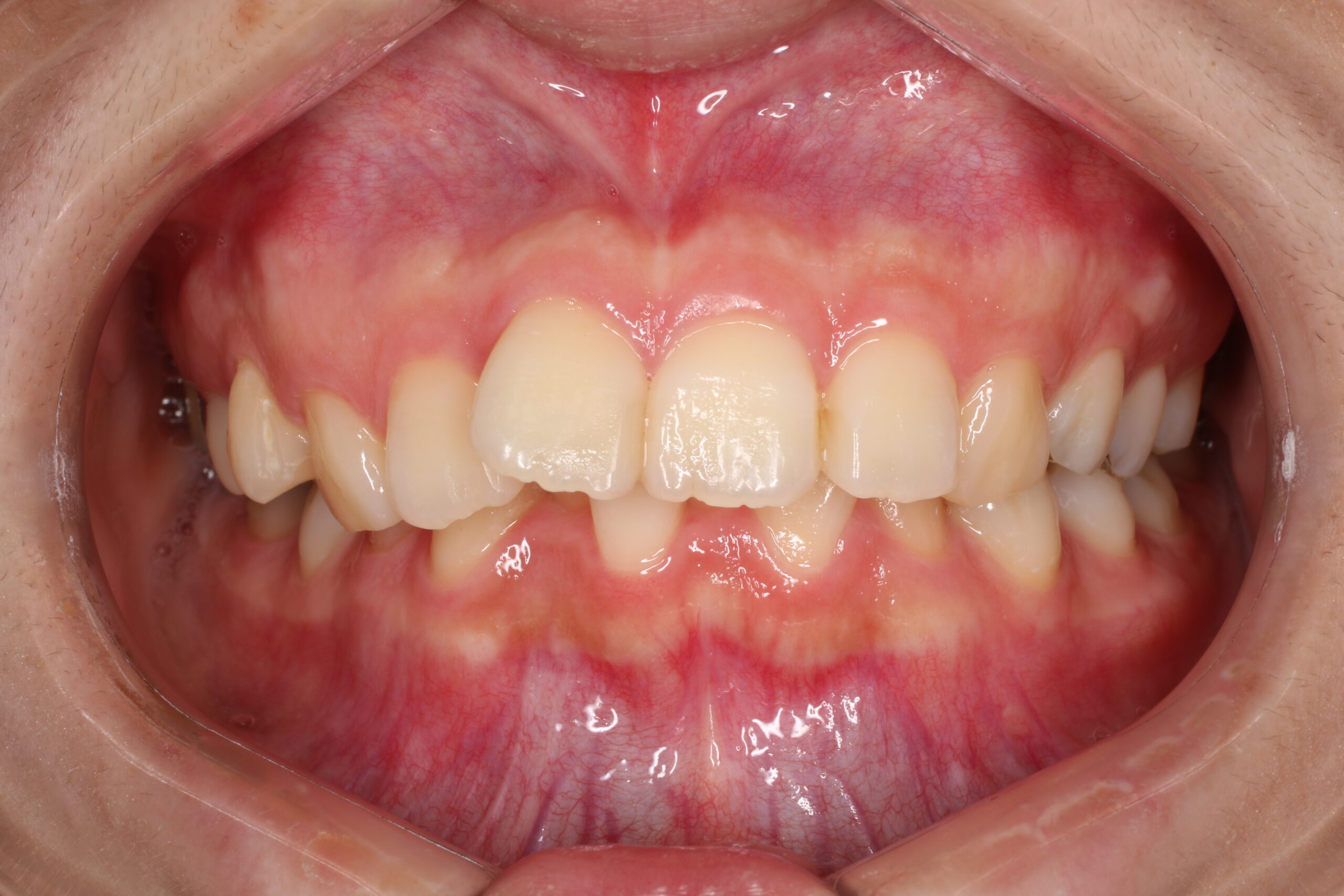 矯正前　難波　矯正