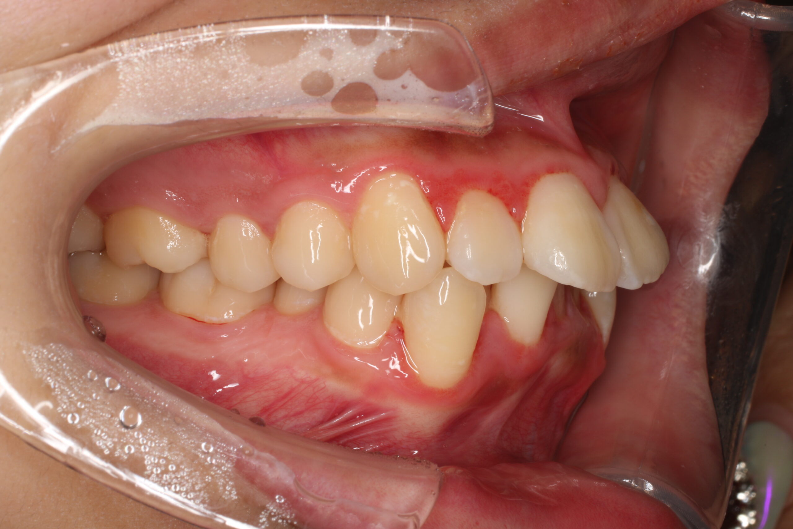 矯正前　口腔内　難波