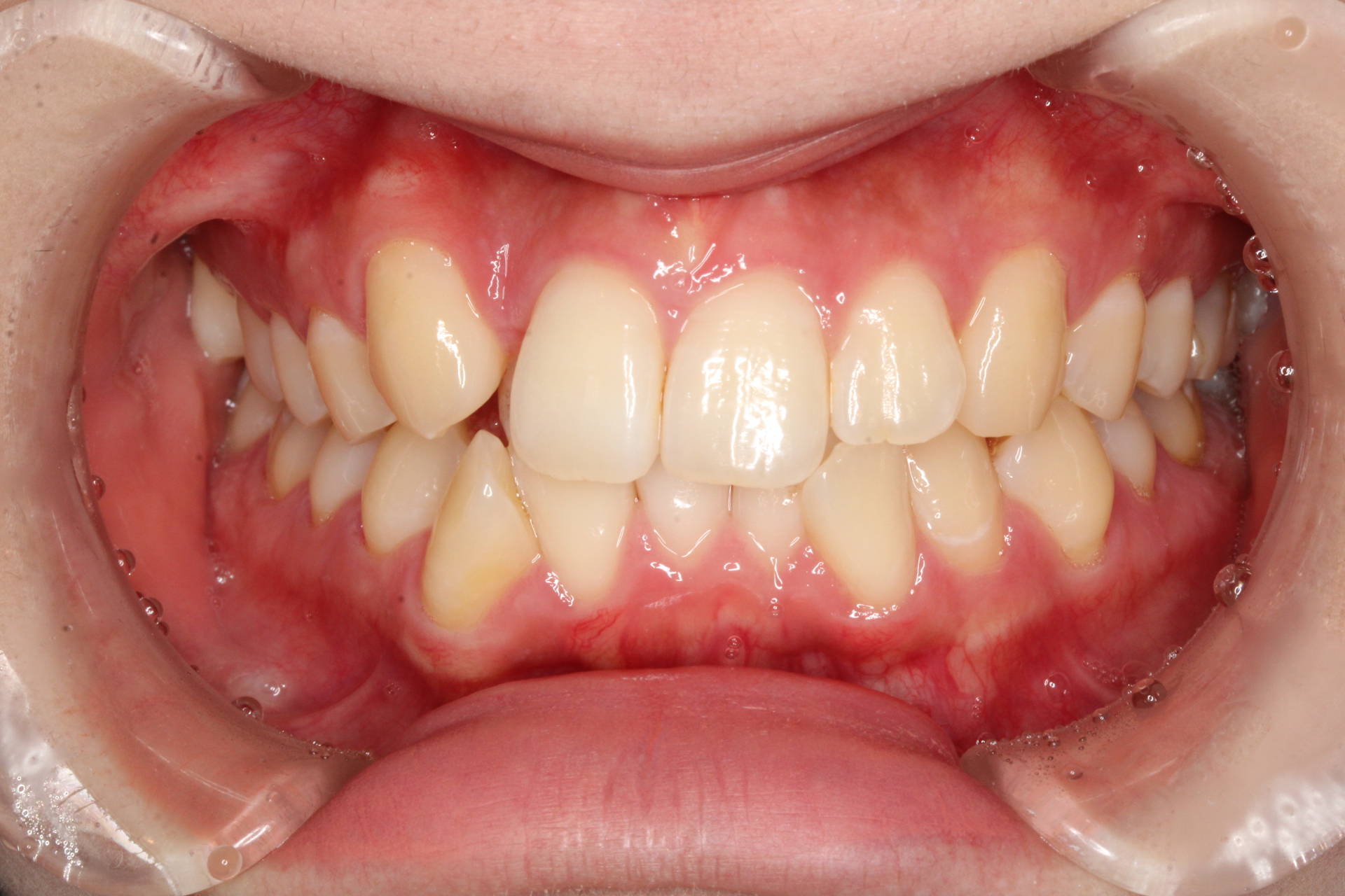 八重歯　矯正前の症例