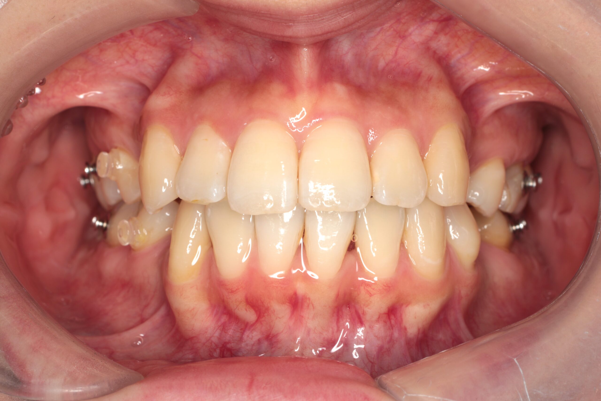 八重歯の症例