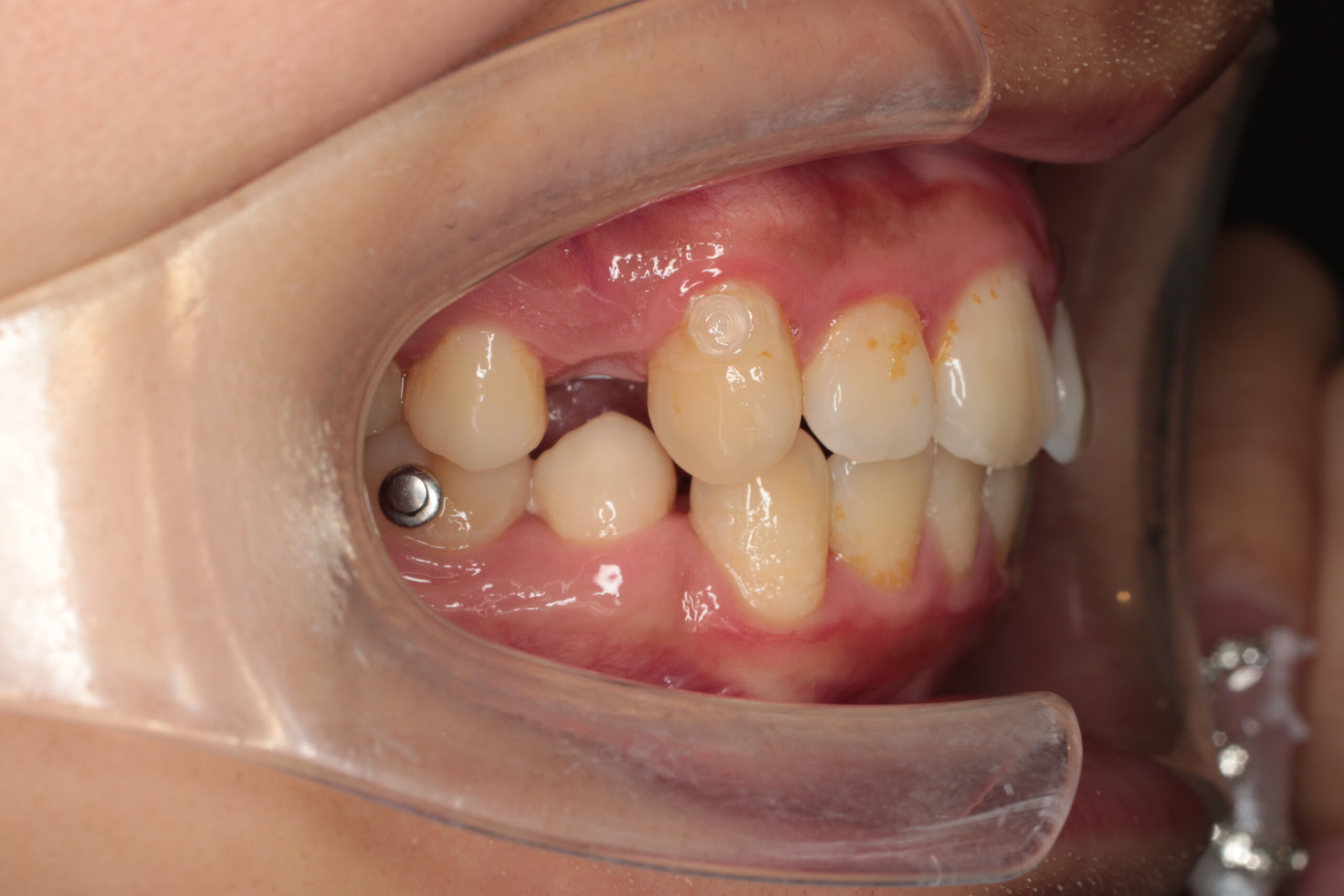 矯正中　難波　矯正