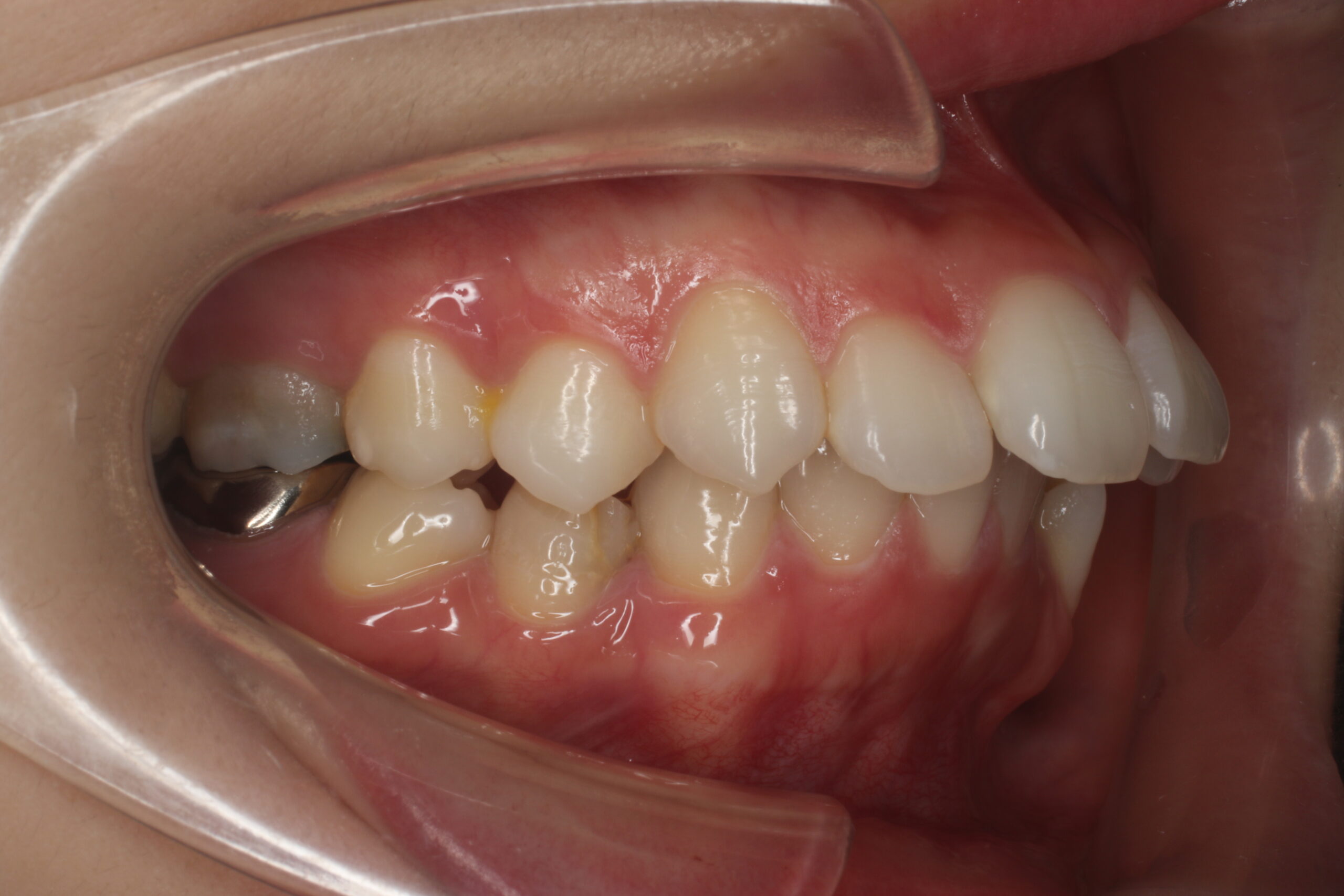 初診　口腔内写真　難波