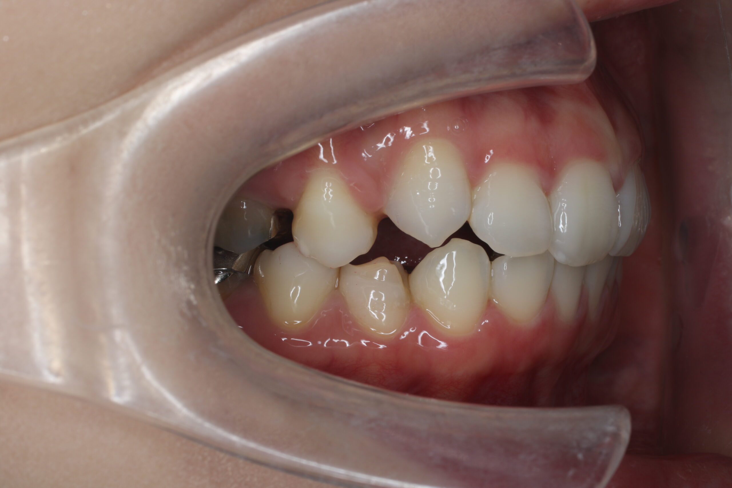 現在　矯正　難波