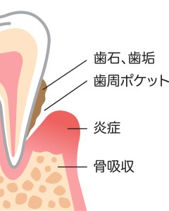 難波　歯列矯正　歯茎
