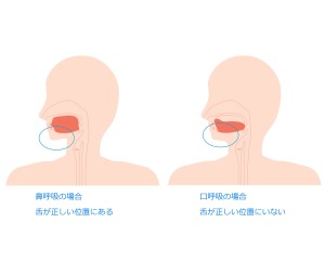 難波　歯列矯正　口呼吸