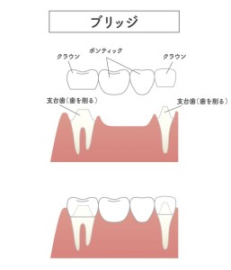 難波　歯列矯正　ブリッジ