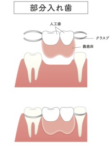 難波　歯列矯正　部分入れ歯
