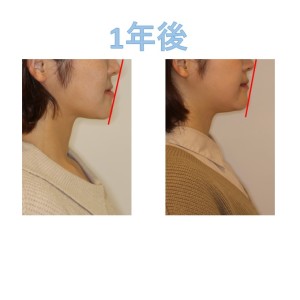 難波矯正歯科　受け口　歯列矯正　歯科矯正
