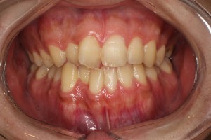 歯の隙間から舌が見えているのはNG