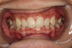 難波矯正歯科　歯列矯正