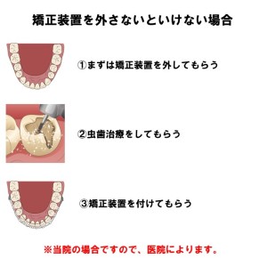 難波　歯科矯正　虫歯